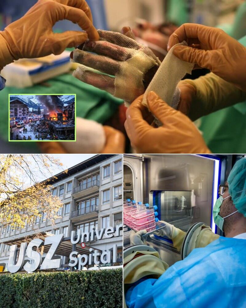 Weeks after the Crans-Montana wildfire, doctors are speaking out – 116 people were injured, many still fighting for their lives as the “critical phase” continues.